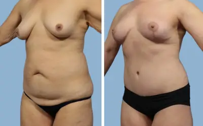Before and After